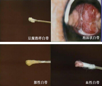 运城白带多怎么治